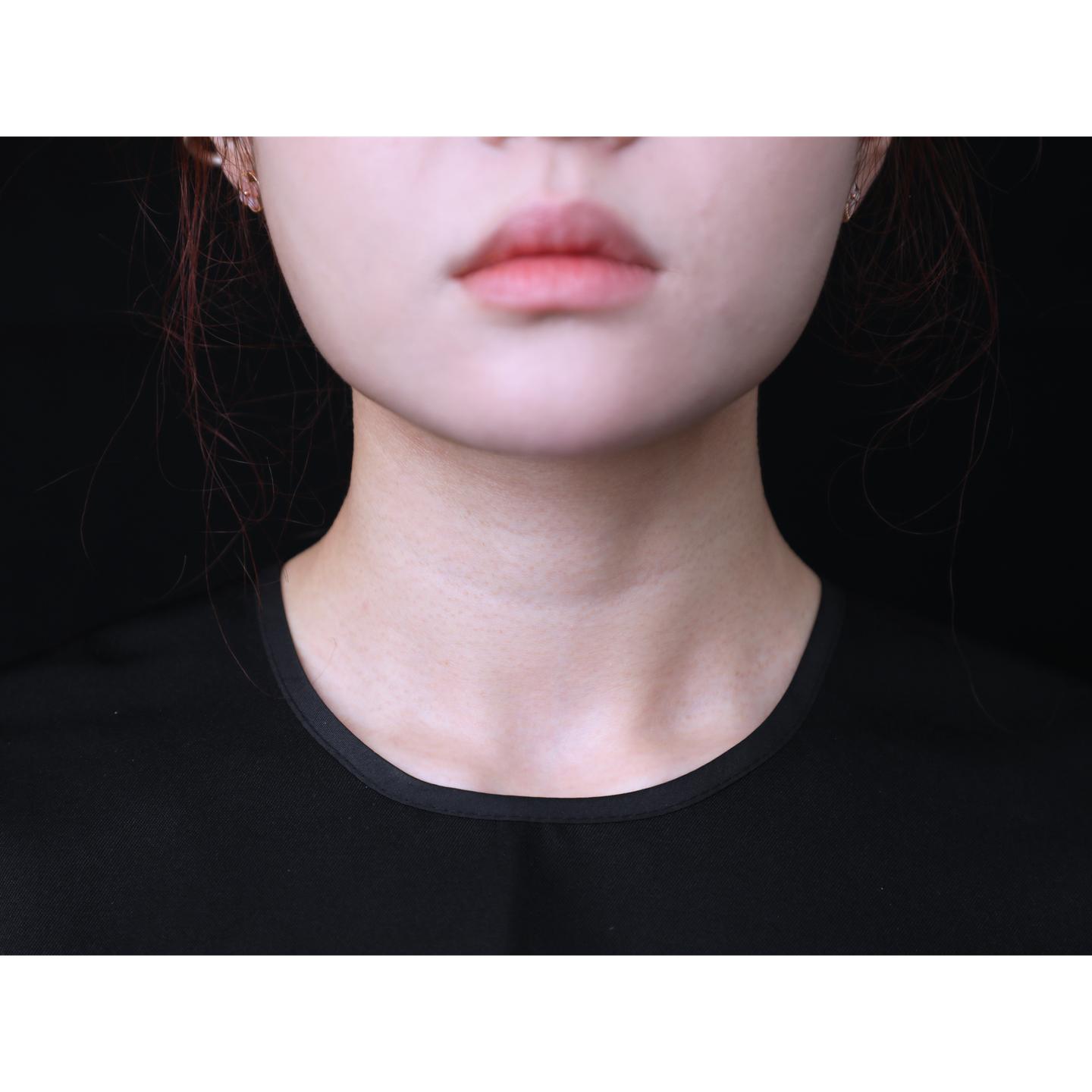 Before — Beatrice Finelines clinical case: neck
