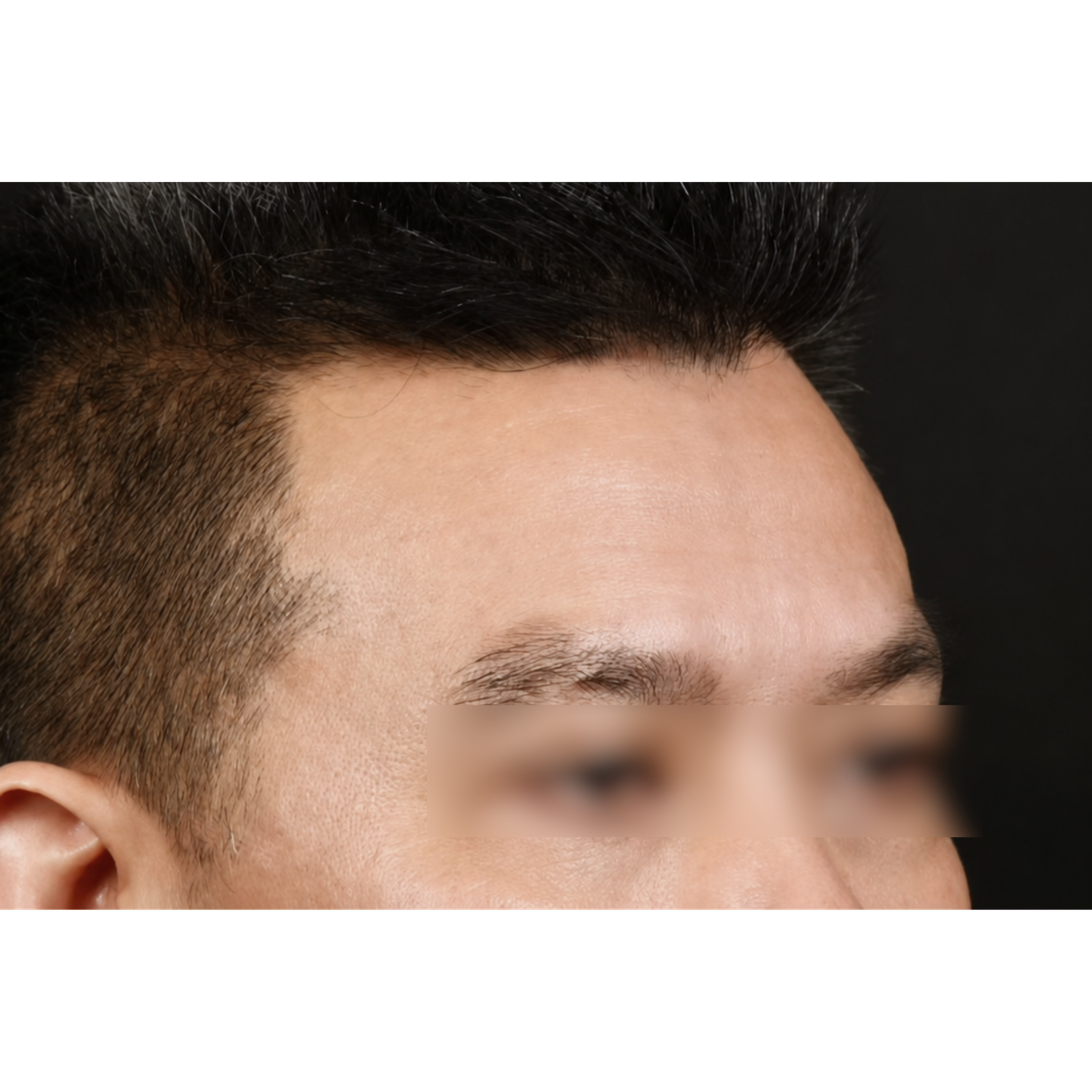 After — Beatrice Finelines clinical case: forehead