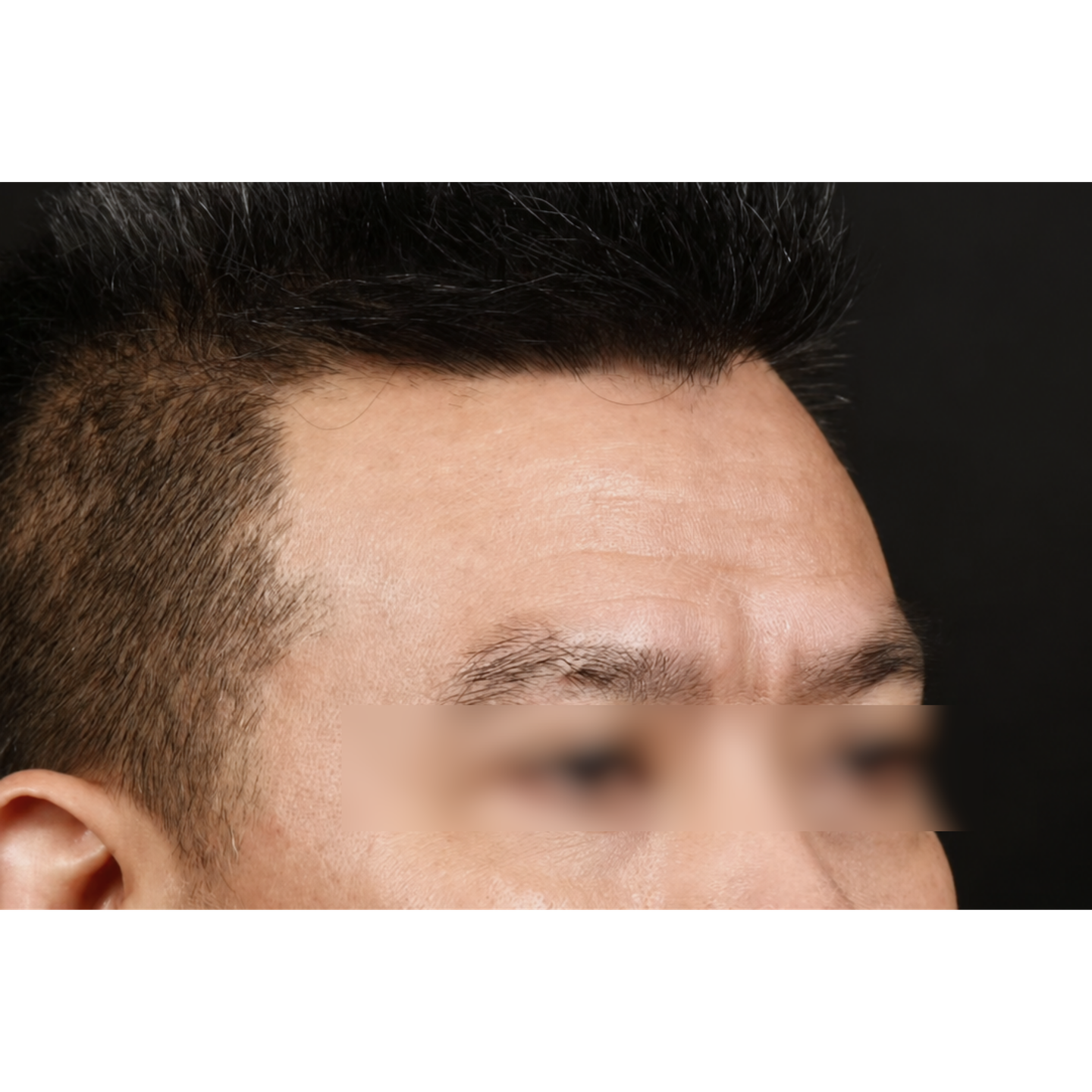 Before — Beatrice Finelines clinical case: forehead