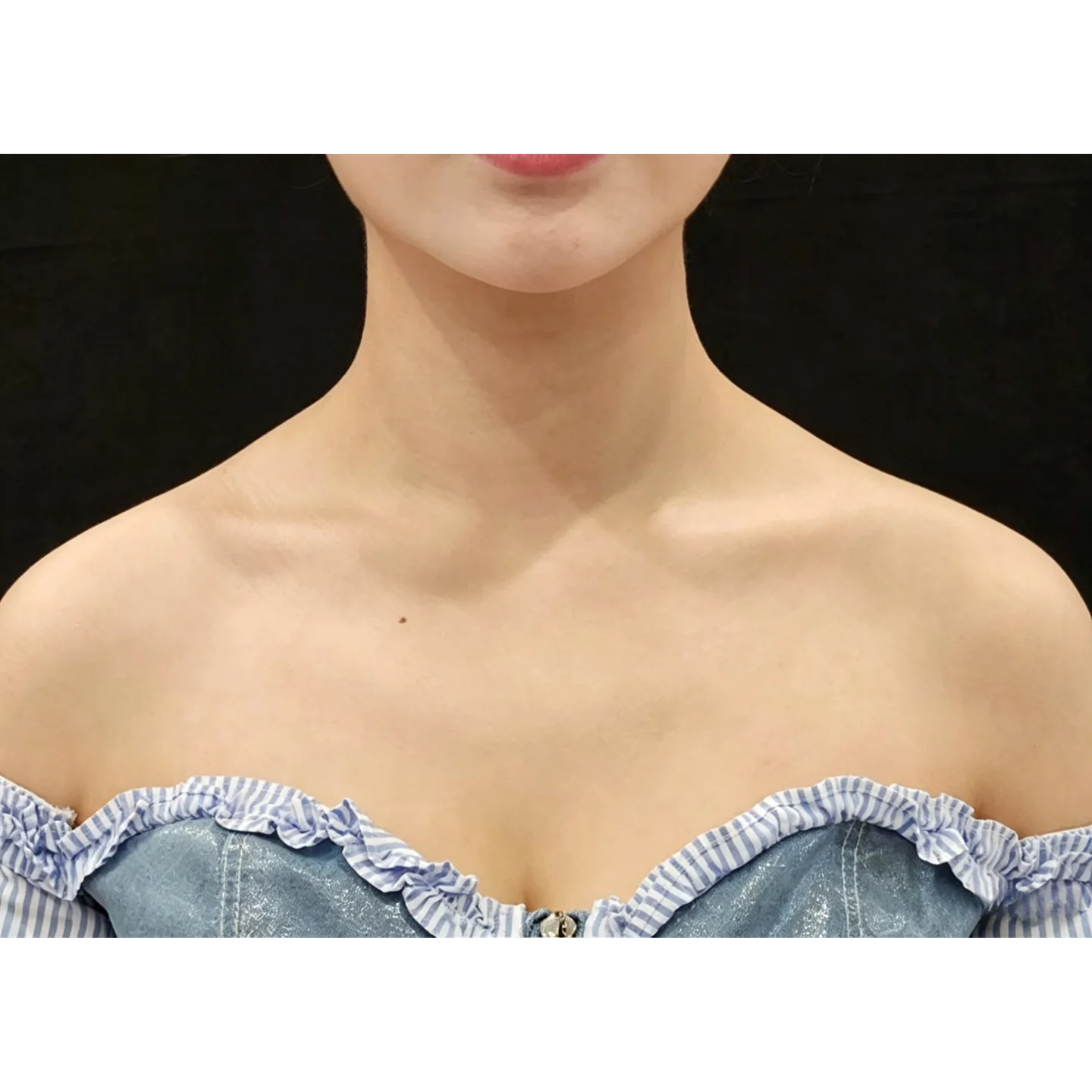 Before — Straight Shoulder — Body