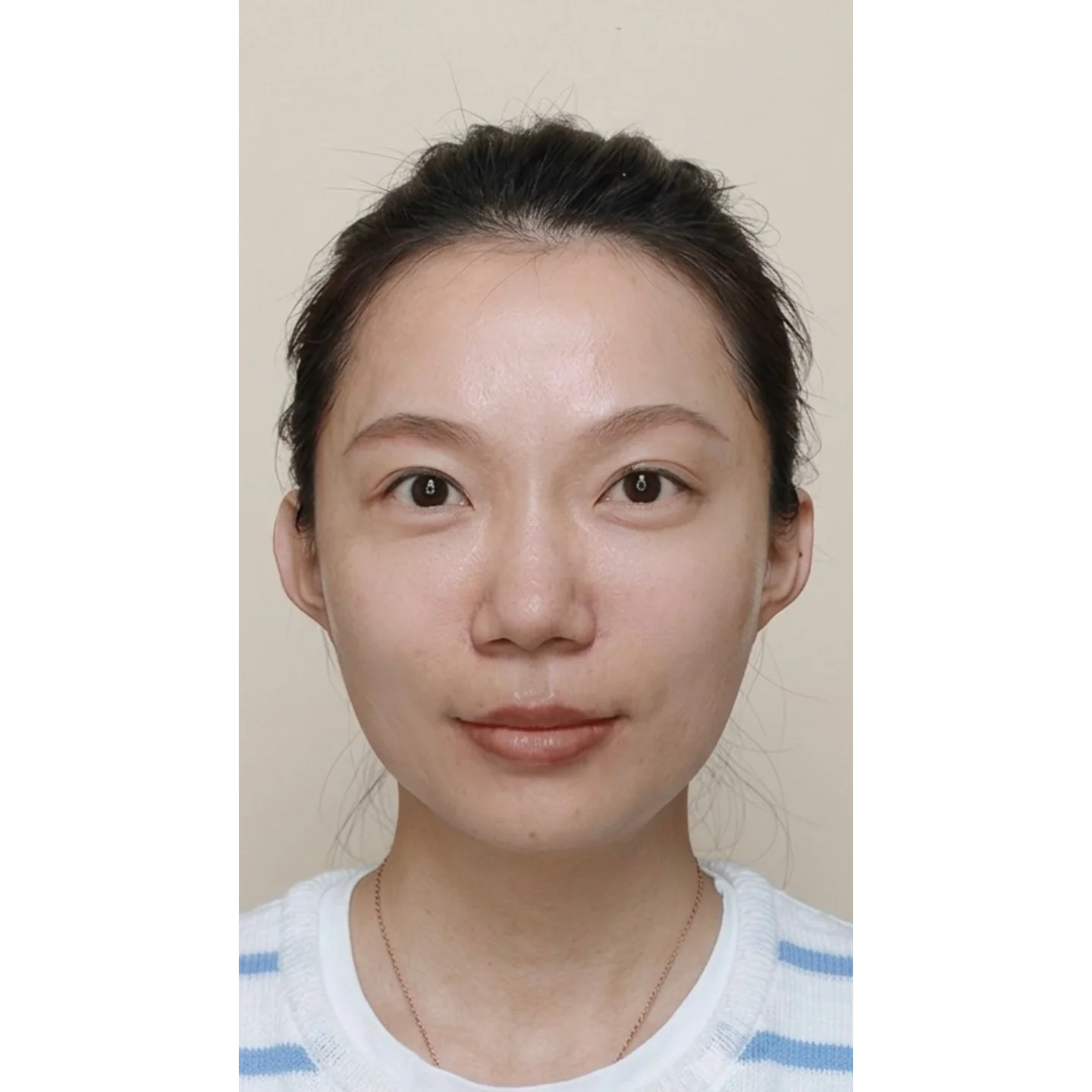 After — Cheek treatment case