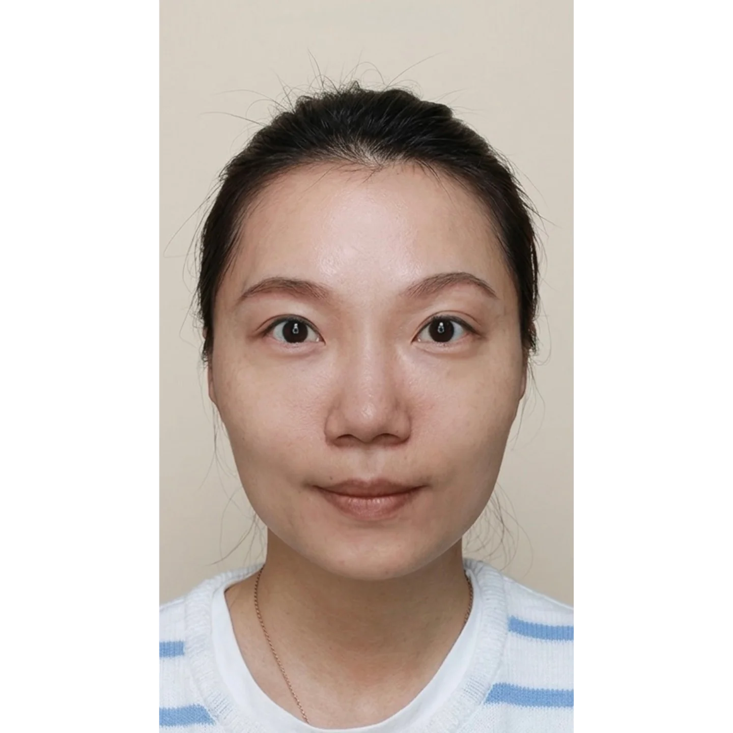 Before — Cheek treatment case