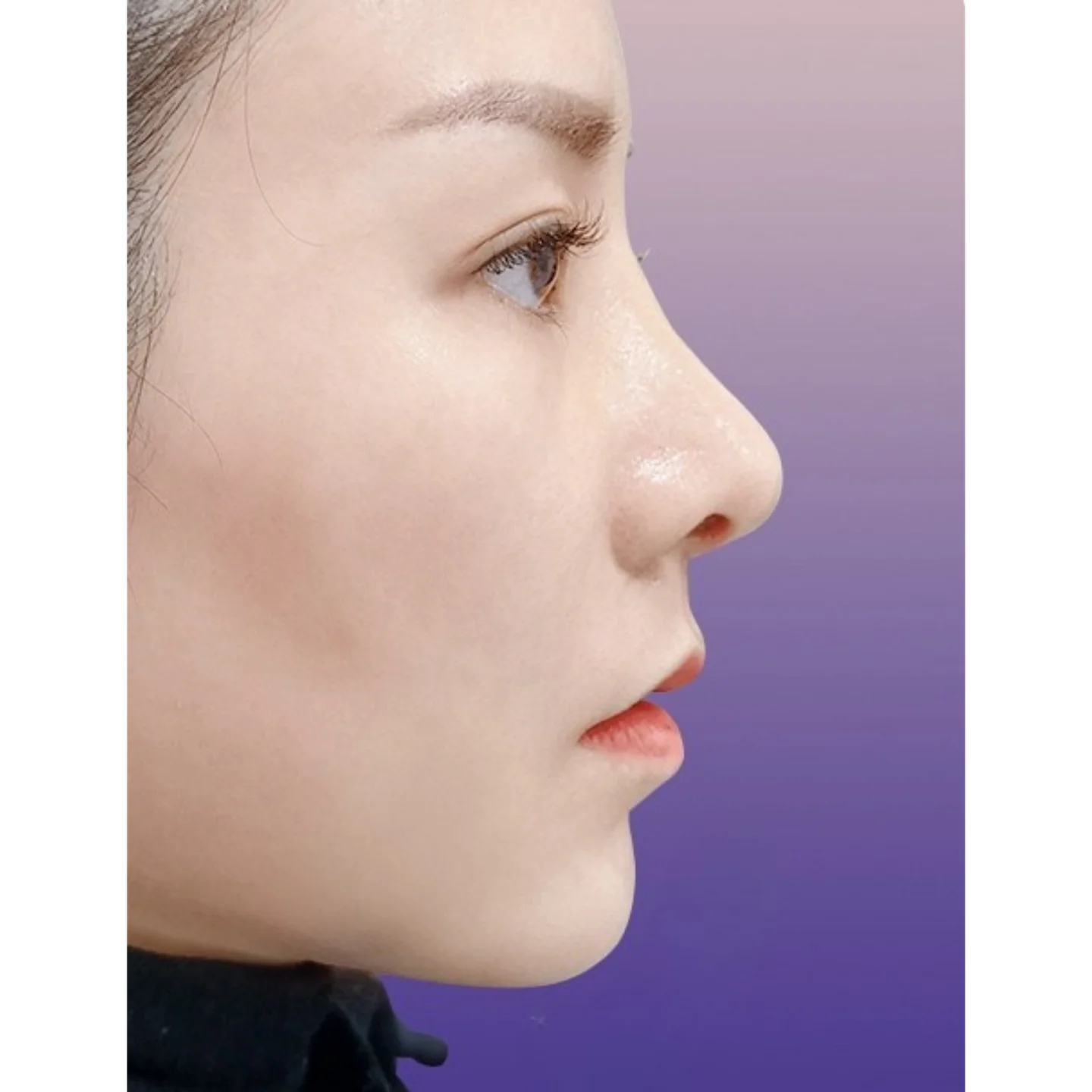 After — Case B — Chin