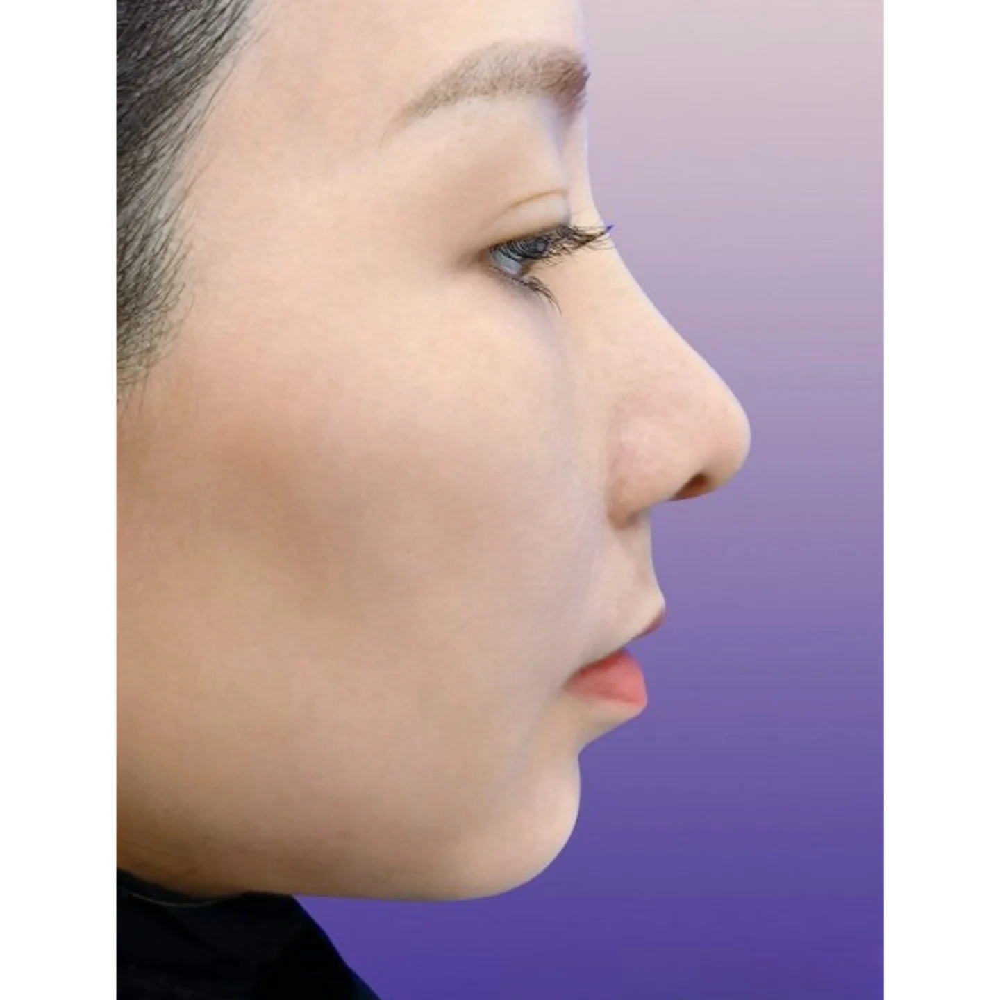 Before — Case B — Chin