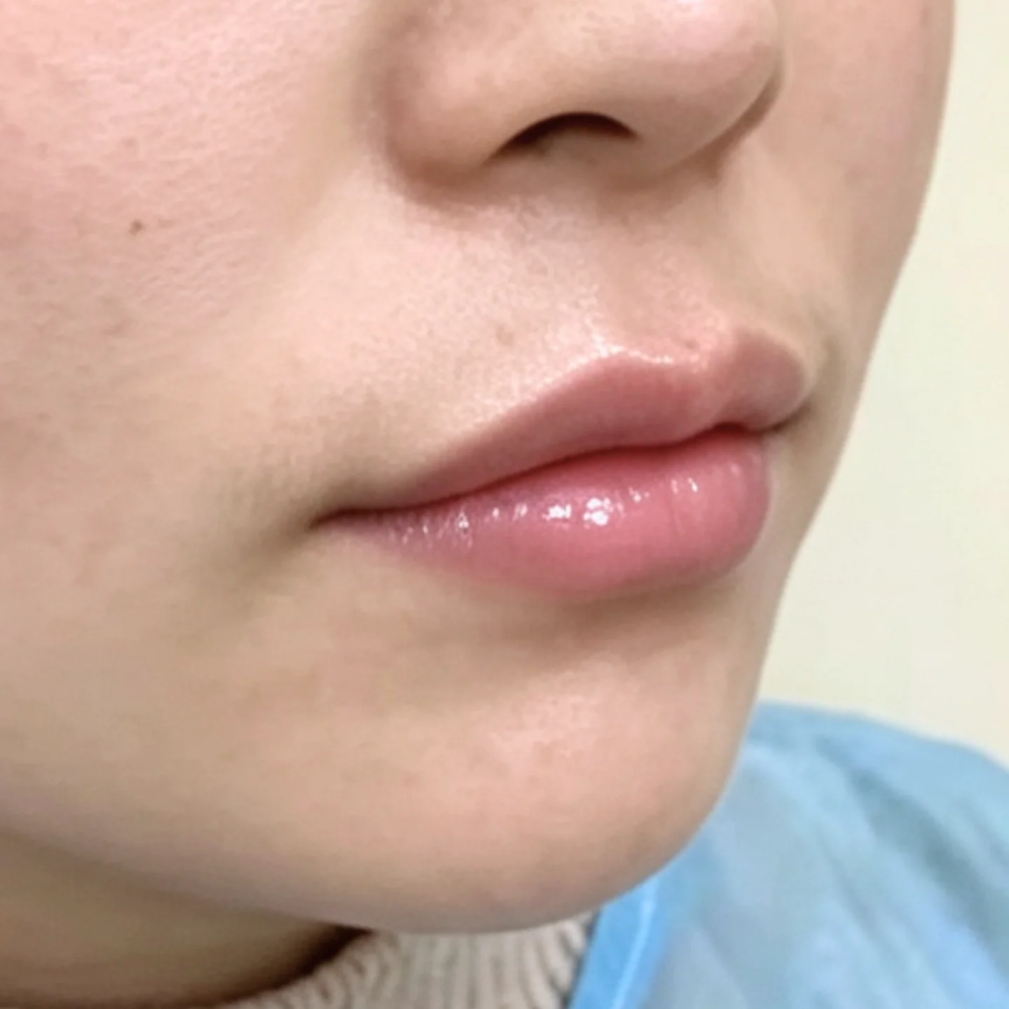 After — Lip Fullness — Lip