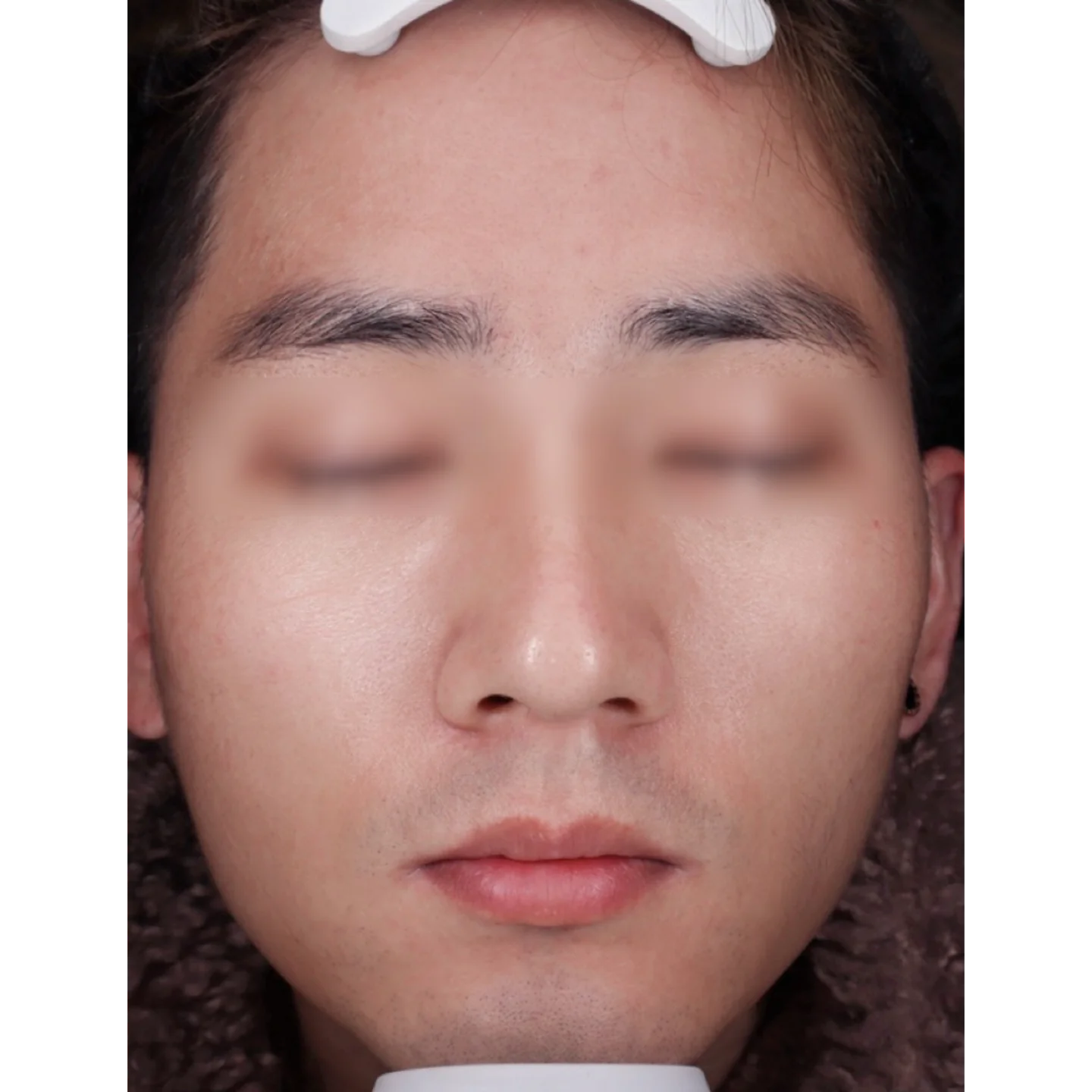 Before — Case A — Mesoderm