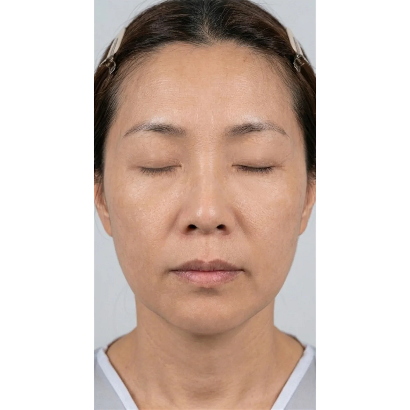 Before — Case B — Mesoderm