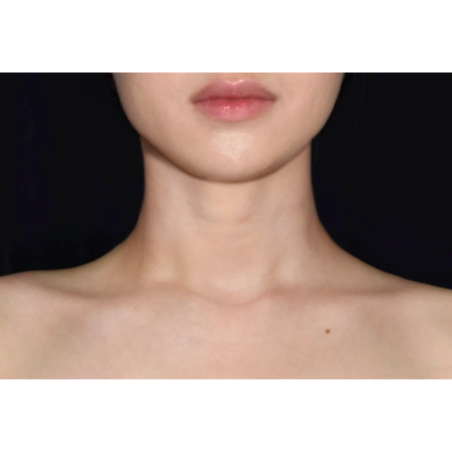 After — Case A — Neck