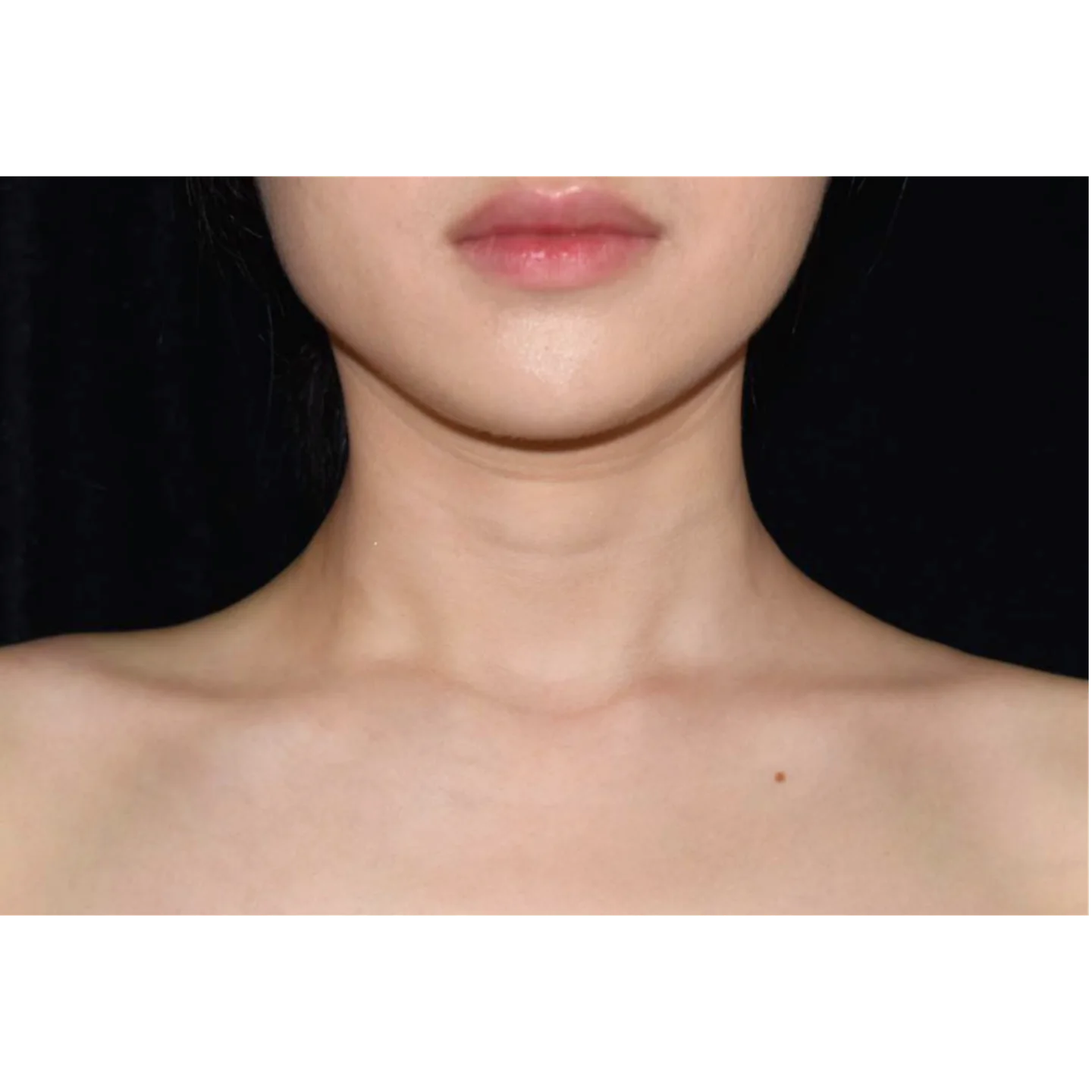 Before — Case A — Neck