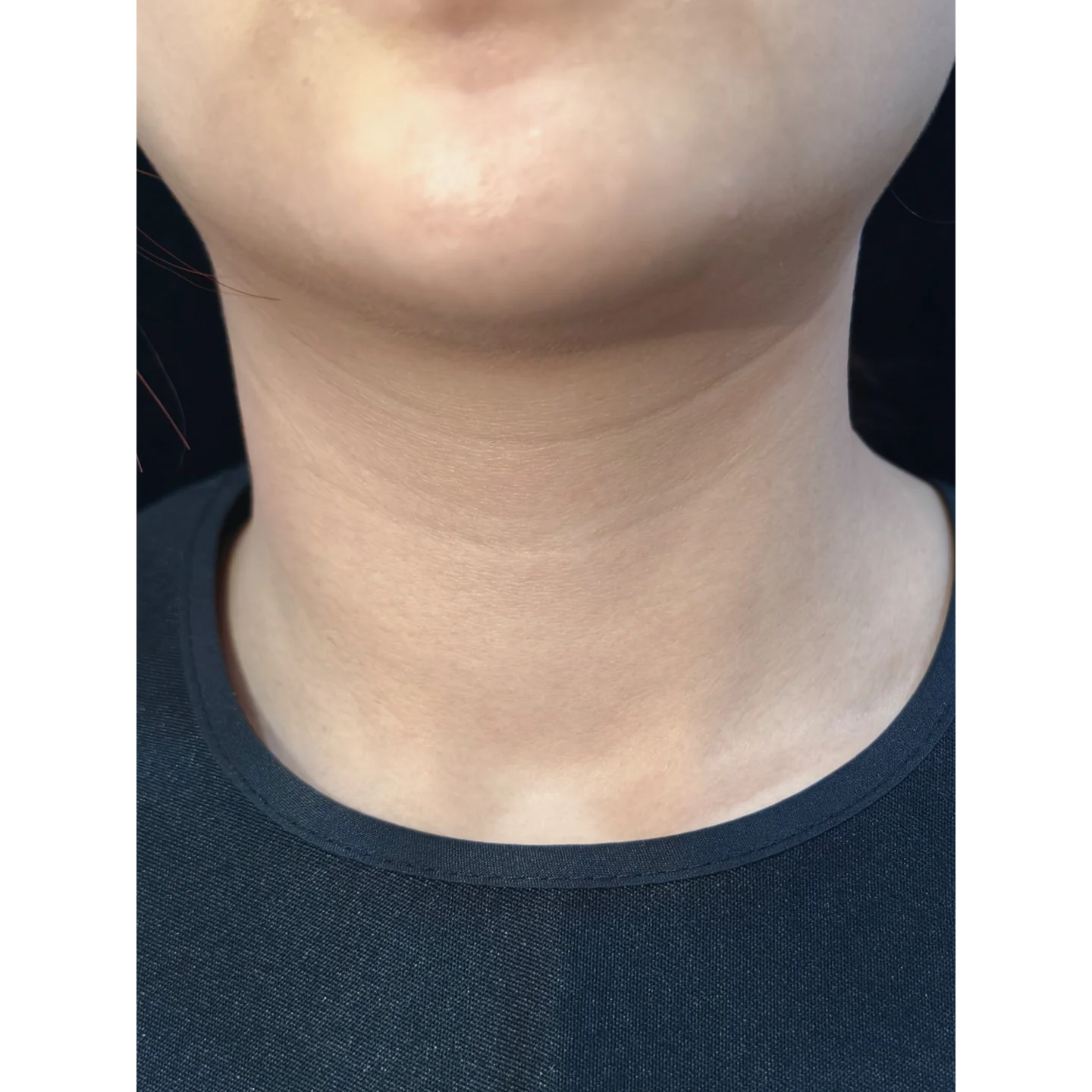 Before — Case B — Neck